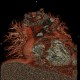 CTEPH, chronic thromboembolic pulmonary arterial hypertension, VRT: CT - Computed tomography